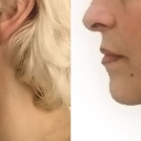 Lifting Viso Prima e Dopo